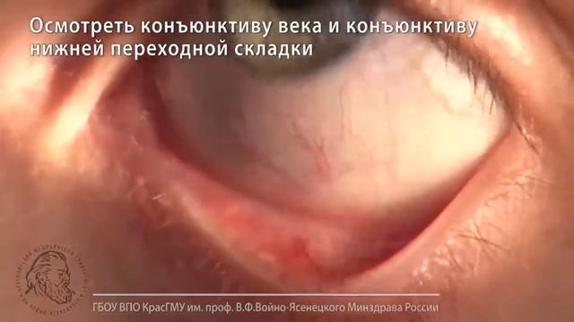 Удаление инородного тела из полости конъюнктивы смотреть онлайн