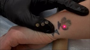 Лазерное удаление татуировки.