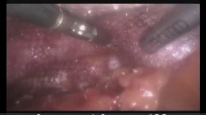 Пупочная грыжа