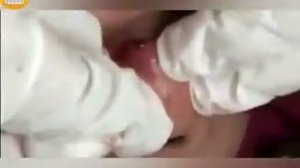 Выдавливание черных точек 
УГРИ - ПРЫЩИ НА ЛИЦЕ! (ДАВЛЮ) К
