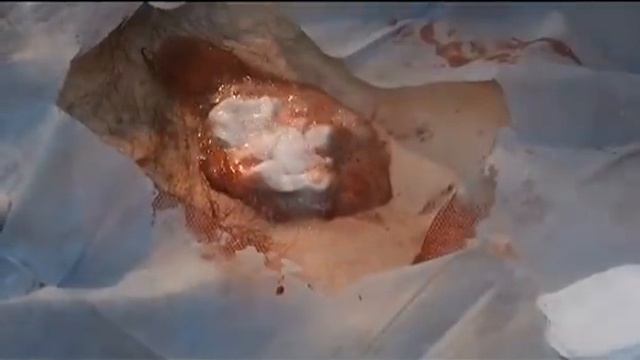 Удаление базалиомы на спине. смотреть онлайн