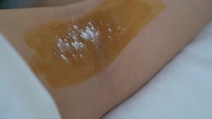 Инъекционная коррекция гипергидроза подмышечных впадин в клинике косметологии Skin Art в Москва-Сит