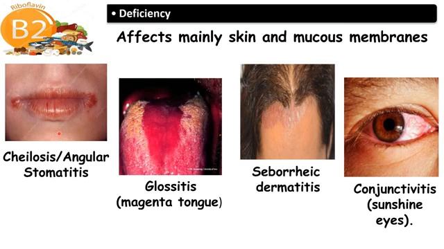 MED.LEVEL 2. GIT module. BIO Lecture 6 Vitamins (part 2) смотреть онлайн