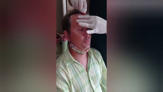 отзывы одного из наших пациентов по пересадке волос ?? смотреть онлайн