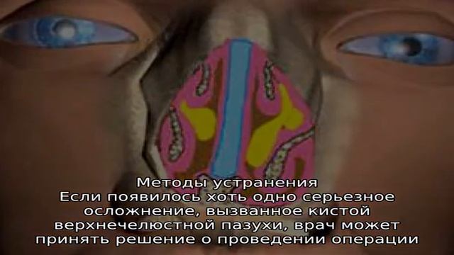 Механизм образования и последствия кисты в гайморовой пазухе