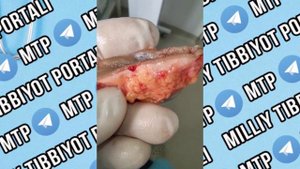 Дермоидная киста копчика  Макропрепарат