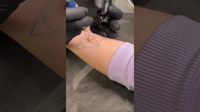 Лазерное удаление тату