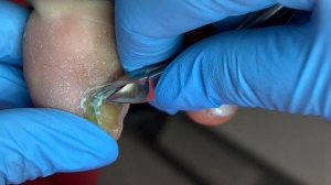 Синегнойная палочка | зачистка | PACT MED |