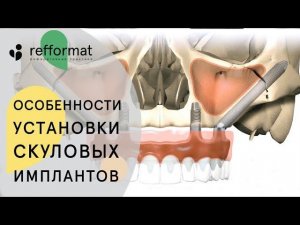 В каких случаях применяют установку скуловых имплантатов. Скуловые имплантаты. 12+