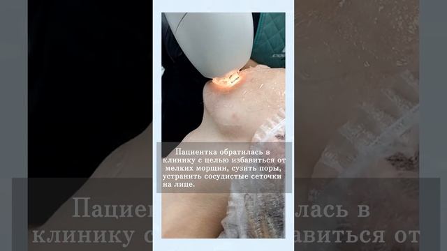Фотоомоложение лица IPL