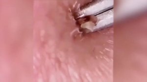 ?️ШОК!!!? ОГРОМНЫЙ ПРЫЩ НА БОРОДЕ?2021?️