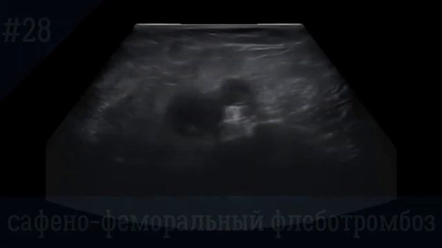 УЗИ сосудов. Сафено - феморальный флеботромбоз.