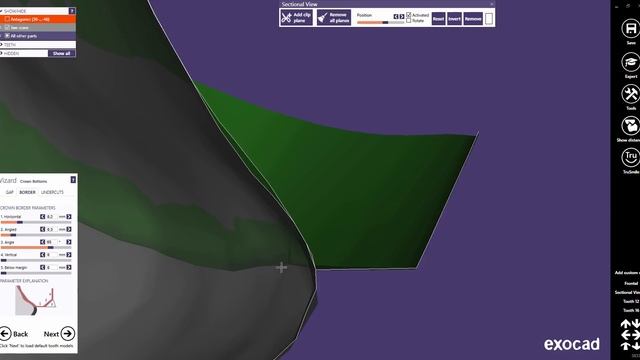 exocad Quick Guide: Crown Bottoms смотреть онлайн