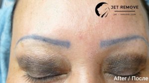 Удаление татуажа синих бровей  ремувером Jet Remove.