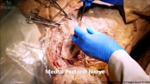 PECTORALIS Major Minor Nerves DP TRIANGLE COSTOCORACOID Membrane S Anterior– Sanjoy Sanyal – Proceu