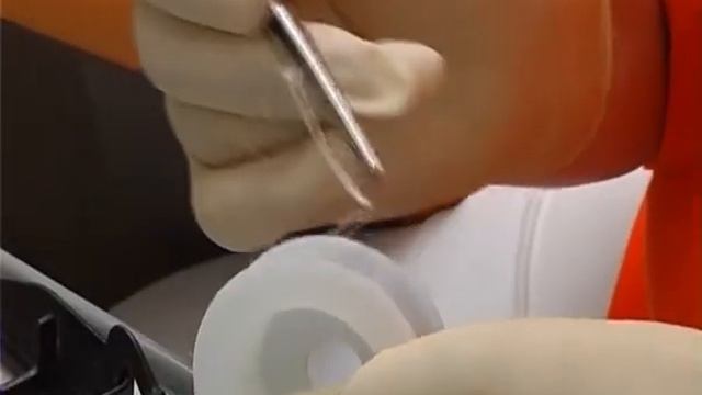 Восстановление травмированного зуба, пластика уздечек смотреть онлайн