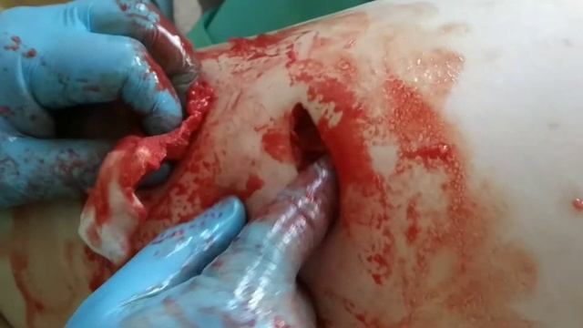 Удаление большой липомы.