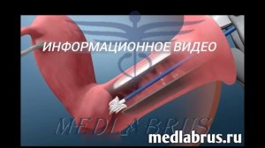 Что происходит во время Папаниколау-теста? или взятие мазка цервикальной щеткой