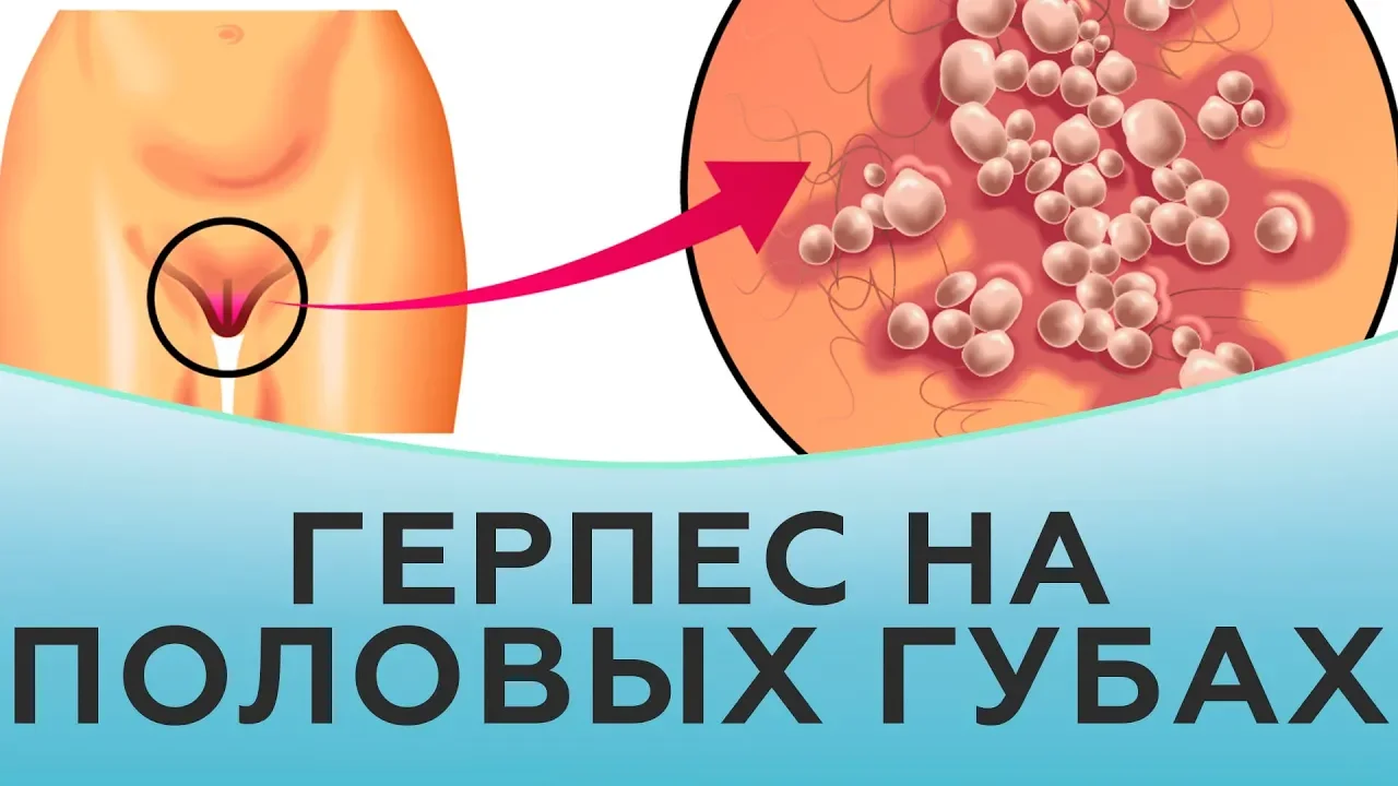 Герпес на половых губах