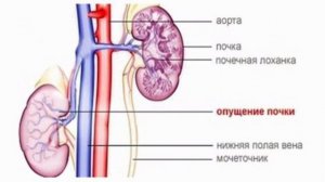 Как жить с опущением почки?