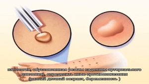 Что такое крапивница и отек Квинке и как их лечить