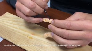 Применение светоотверждаемого материала "Нолатек"