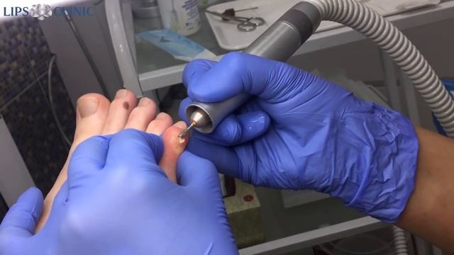 Удаление стержневых мозолей