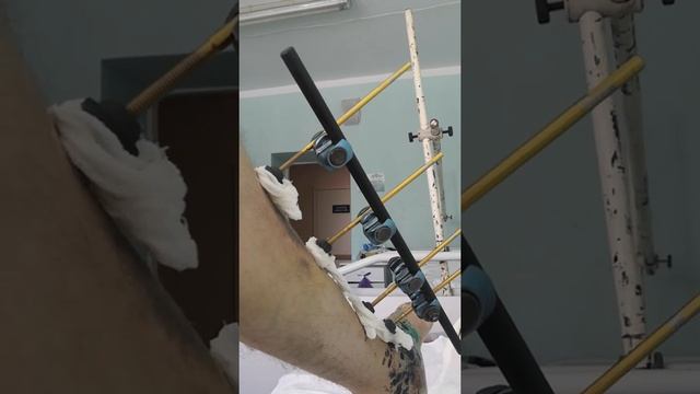 переломы пяток смотреть онлайн