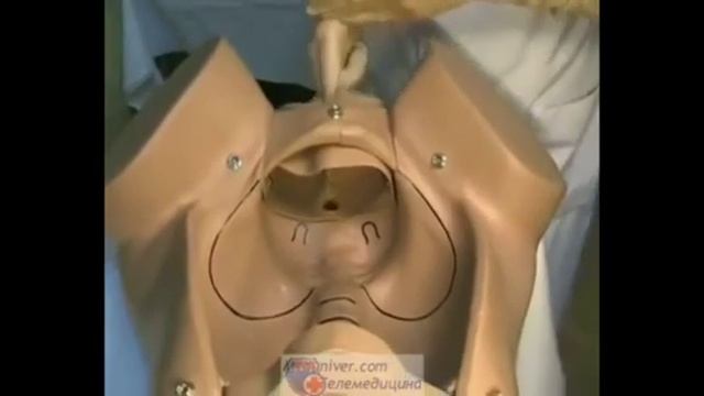 Босану биомеханизмі, кезең бойынша босану ағымын жүргізу.