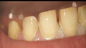 Препарирование зубов под виниры. Final preparations for veneers