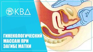 ✅ 1474  Гинекологический массаж при загибе матки