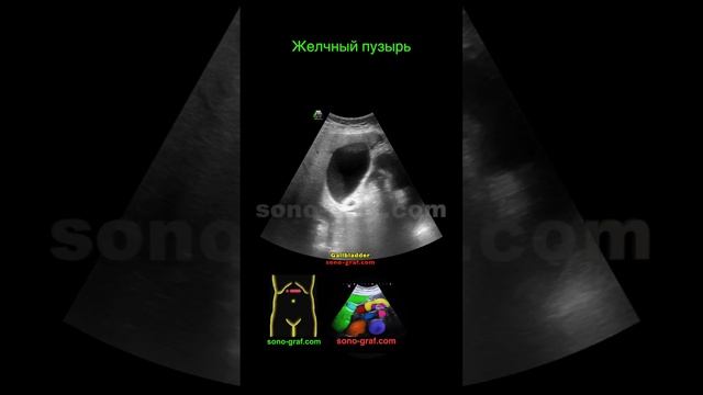 УЗИ - Сладж В Желчном Пузыре