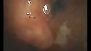 Колоноскопия, хромоскопия, неоплазии кишечника