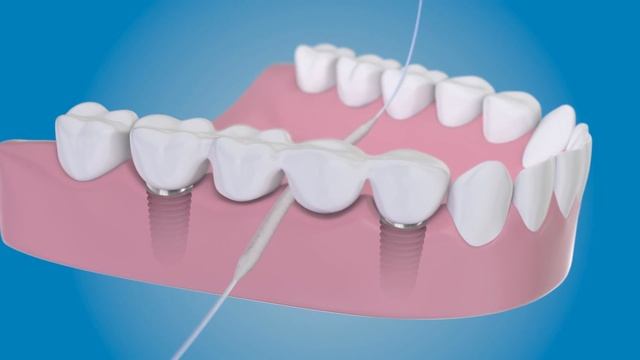 Суперфлосс, как чистить вокруг имплантатов с помощью TePe Bridge & Implant Floss