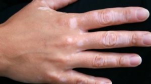 Oqish dog`lar sababi nima ✿❀ Оқиш доғлар сабаби нима