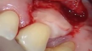 Устранение рецессии десны