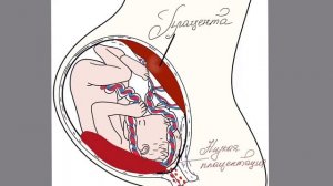 Плацента. Предлежание плаценты. Отслойка плаценты.