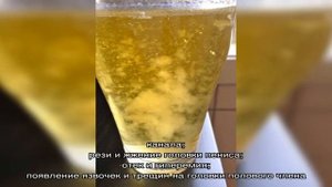 Причины появления хлопьев в моче