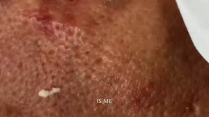 Big blackheads.