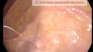 Как улучшить детекцию при проведении колоноскопии? Опыт городской клинической больницы № 6, Минск