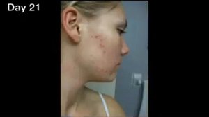 Роаккутан Фото До и После 1 Месяца Лечения