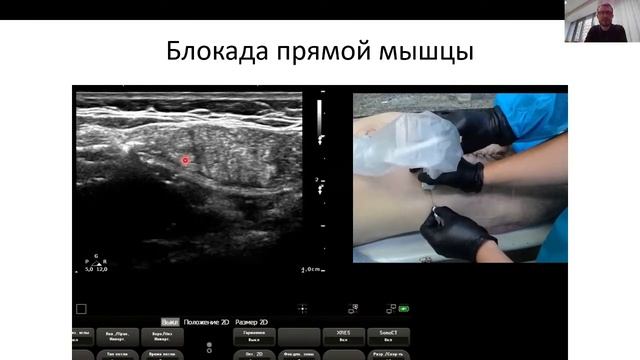 Миофасциальные блокады и нейроаксиальные методы анестезии под контролем ультразвука