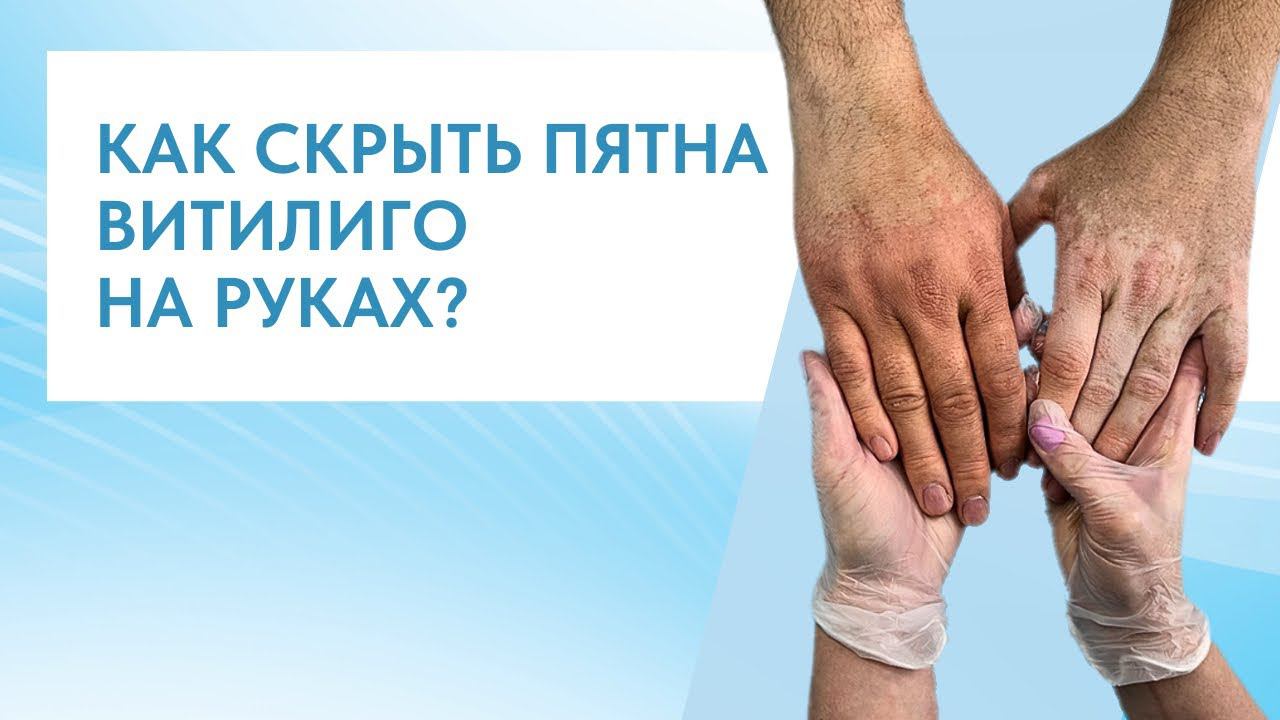 ВИТИЛИГО НА РУКАХ | КАК СКРЫТЬ ВИТИЛИГО?