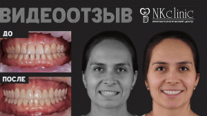 Неправильный прикус и головные боли. Видеоотзыв пациентки NKclinc