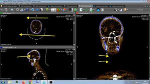 ГЕМОРРАГИЧЕСКИЙ ИНСУЛЬТ НА КТ.