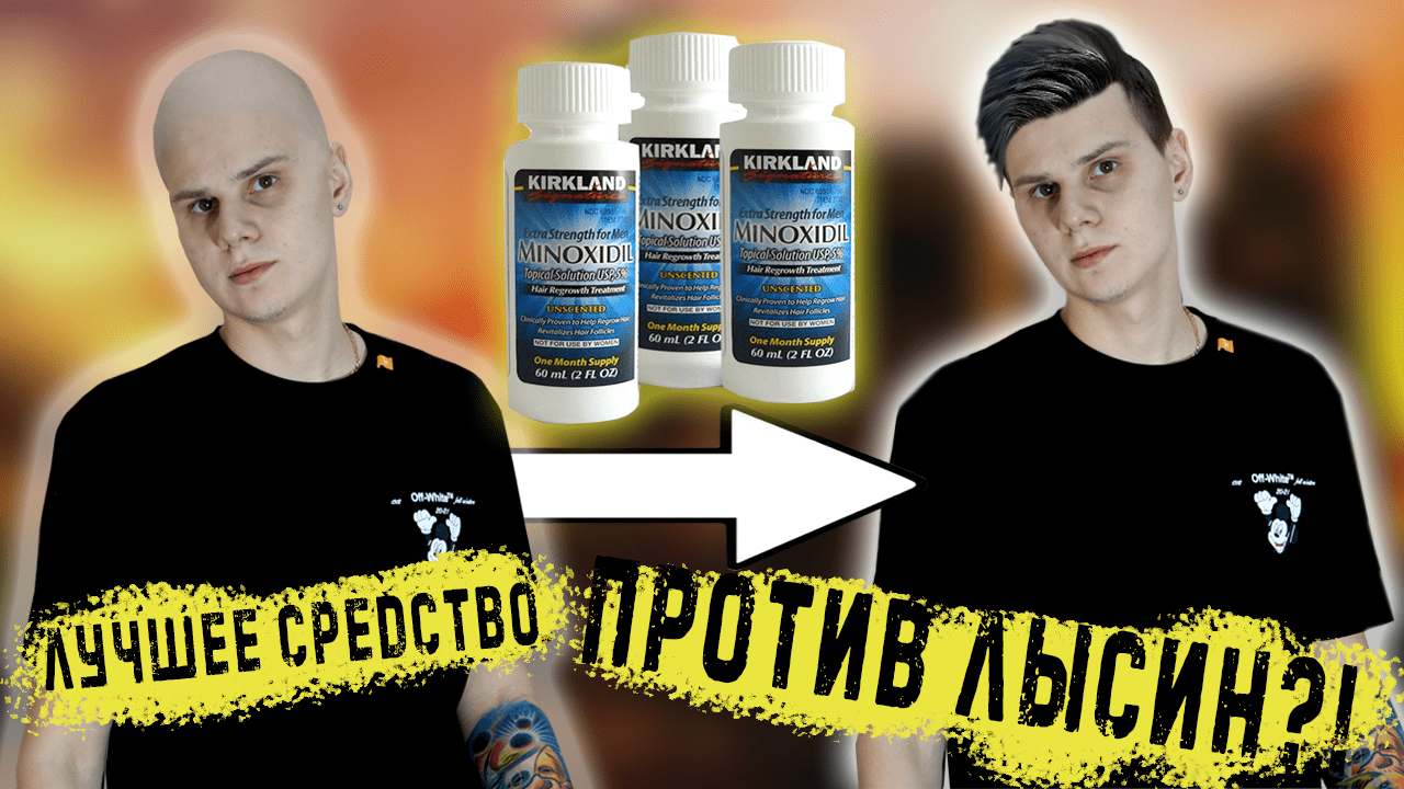#лысина #облысение #выпадениеволос
КАК ПОБЕДИТЬ ЛЫСИНЫ ? МИНОКСИДИЛ (Minoxidil) / УНИЧТОЖАЮ ЛЫСИНЫ