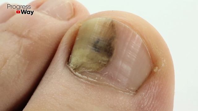 Грибок Ногтей Исчезнет За 5 Минут, Если Применять Эти Способы! Лечение Грибка Ногтей Легко и ПРОСТО смотреть онлайн