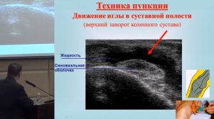 Хитров Н.А., «Остеоартроз или Остеоартрит - за каким названием будущее?»