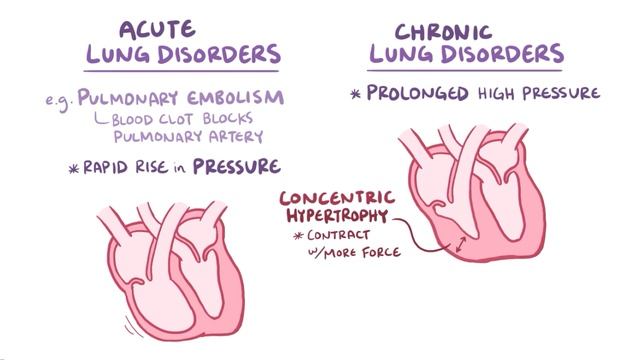Легочное Сердце Cor Pulmonale