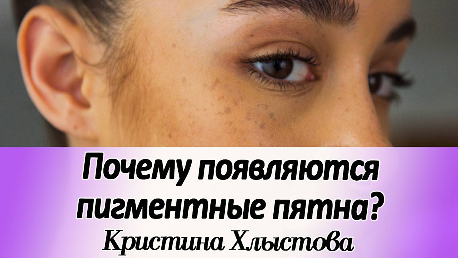 Почему появляются пигментные пятна и как от них избавиться? | Кристина Хлыстова